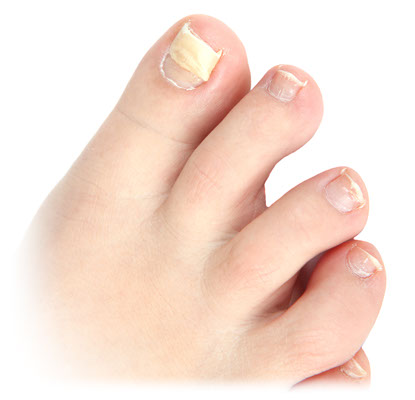 ingrown toe nails
